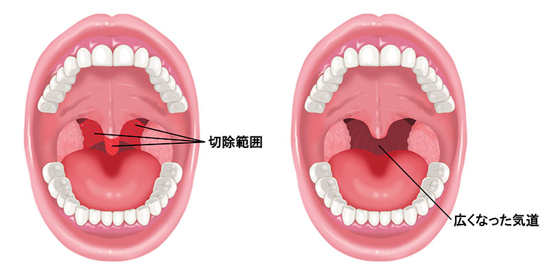手術の切除部位と術後のイメージ